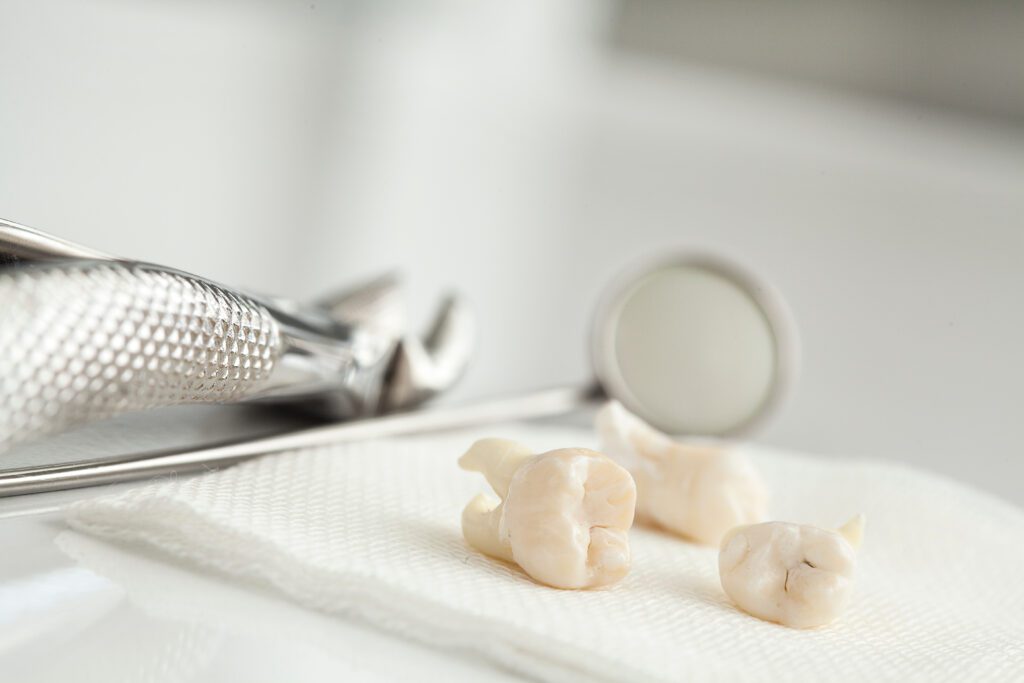 Tooth extractions