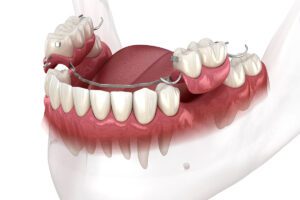 Removable partial denture, mandibular prosthesis. Medically accu