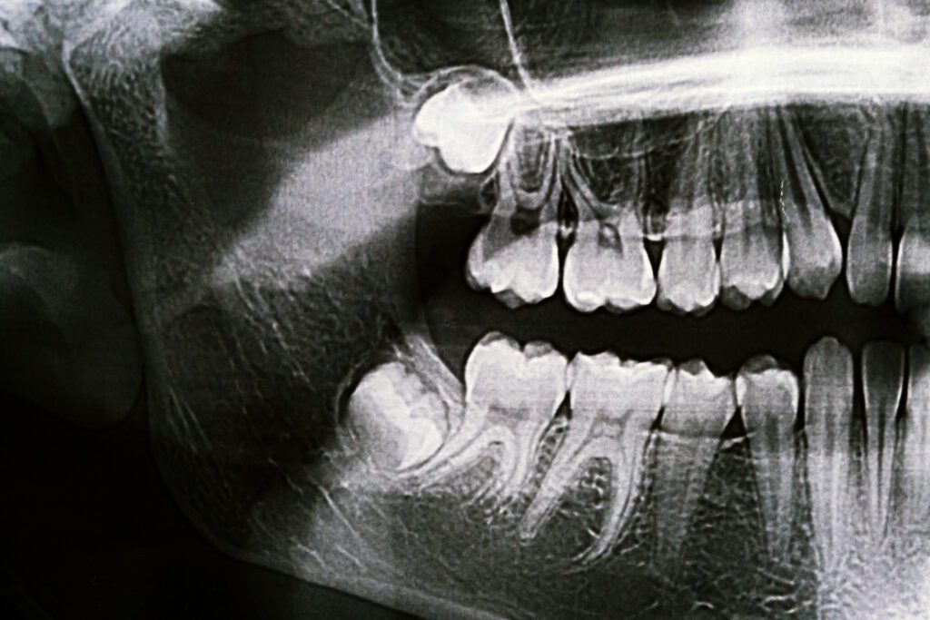 wisdom tooth extraction